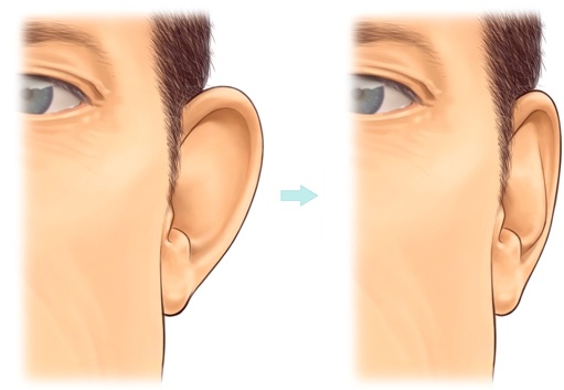 ear-correction-surgery-otoplasty