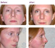 rhinoplasty-nose-job-birmingham