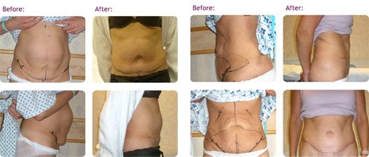 Simple Aftercare: 5 Tummy Tuck Recovery Tips - Harley Clinic