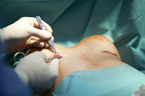 undergoing-breast-enlargement-surgery