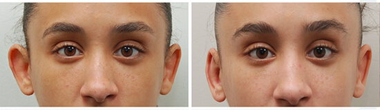 otoplasty before and after