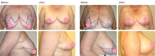 breast-reduction