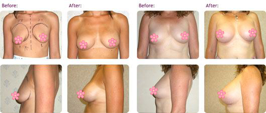 breast-implants