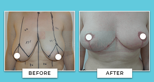 Breast Reduction Manchester