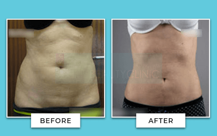 Tummy Tuck Surgery Birmingham UK