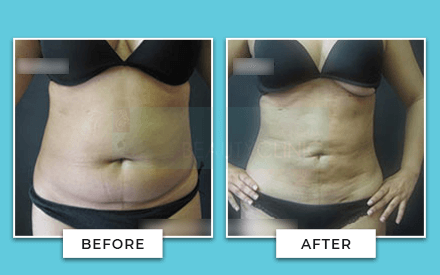 tummy tuck before and after 6