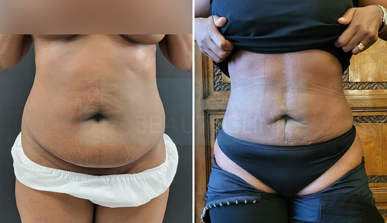 Liposuction Birmingham UK, Liposuction Before and After