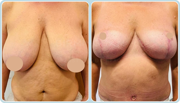 abdominoplasty combines with vaser liposuction and breast reduction