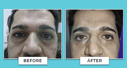 Blepharoplasty Before And After
