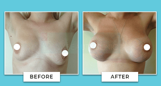 Breast Uplift Before And After
