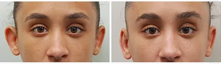 ear-correction-before-after