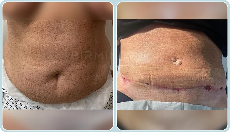 abdominoplasty before and after