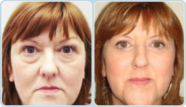 blepharoplasty before and after result