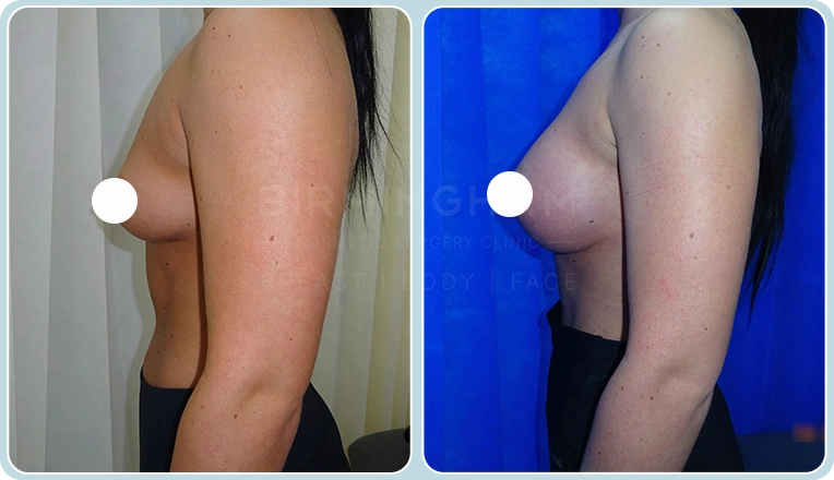 breast enlargement before and after result
