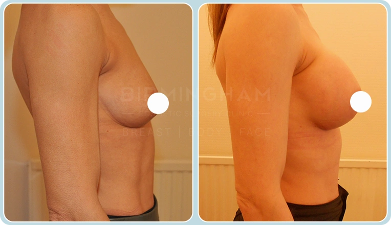 breast enlargement before and after result