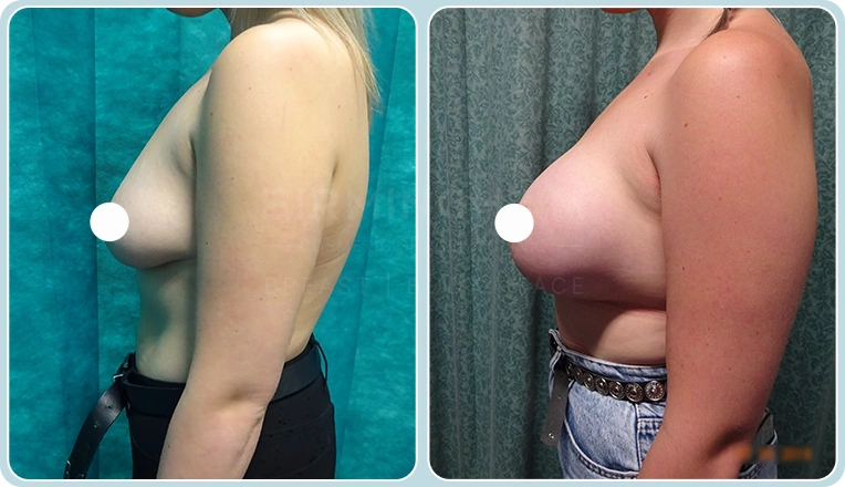breast enlargement before and after result