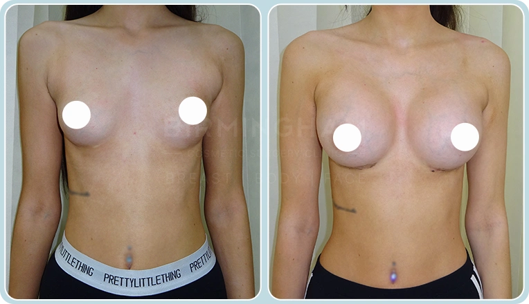 breast enlargement before and after result
