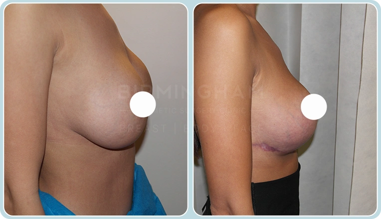breast lift before and after result