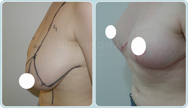 breast reduction before and after result