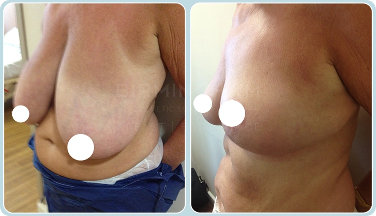 breast reduction before and after result