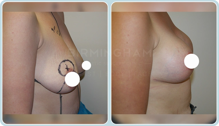 breast uplift before and after result