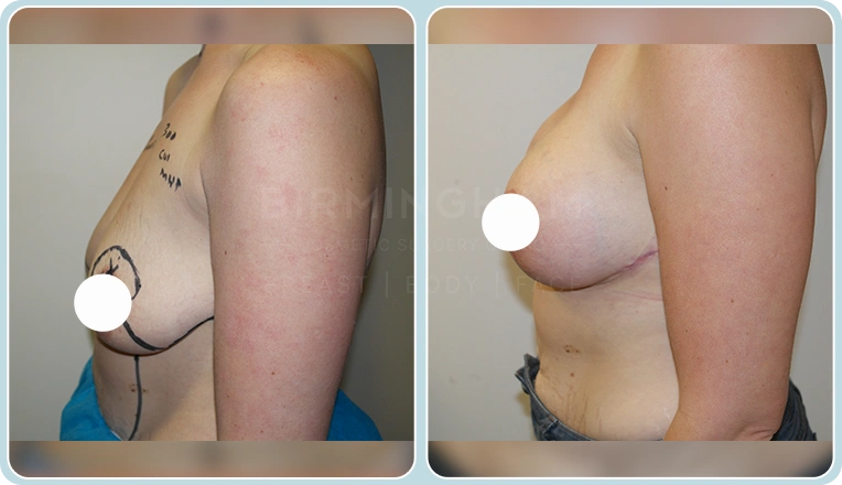breast uplift before and after result