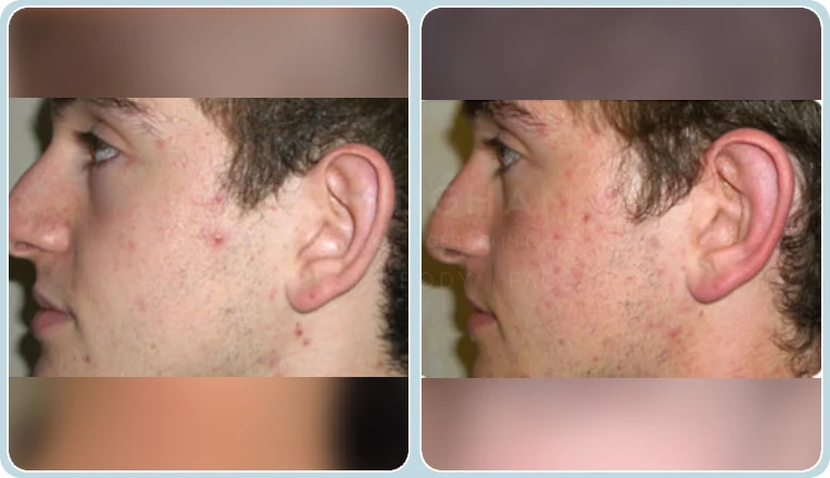 ear correction before and after