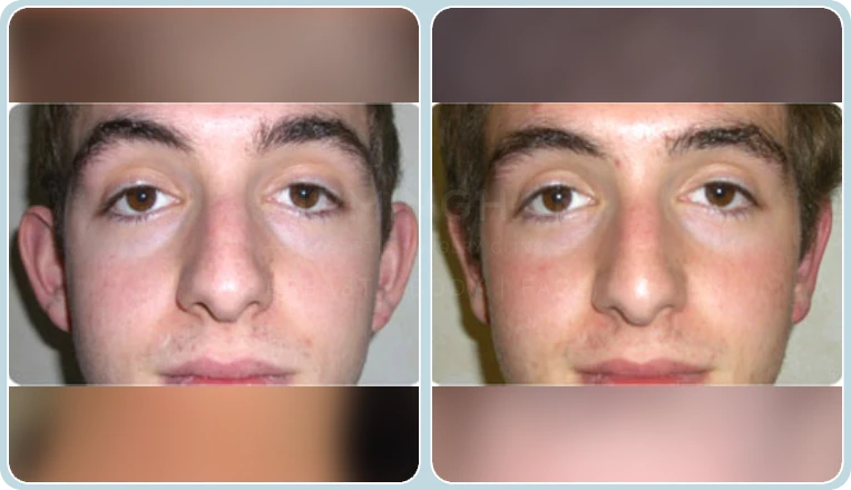 ear correction before and after