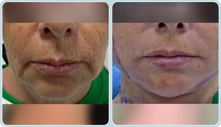 facelift before and after