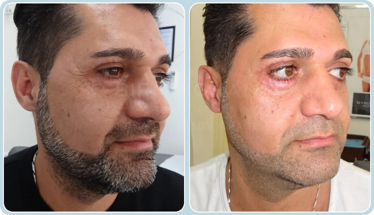 lower eyelid blepharoplasty before and after