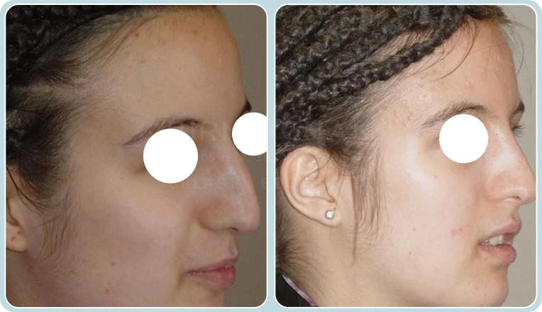 nose job before and after