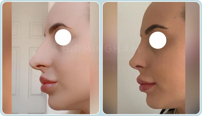 nose job before and after