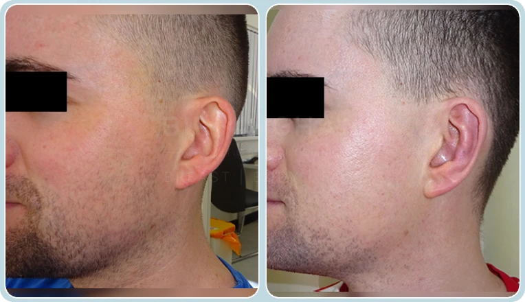 otoplasty before and after result