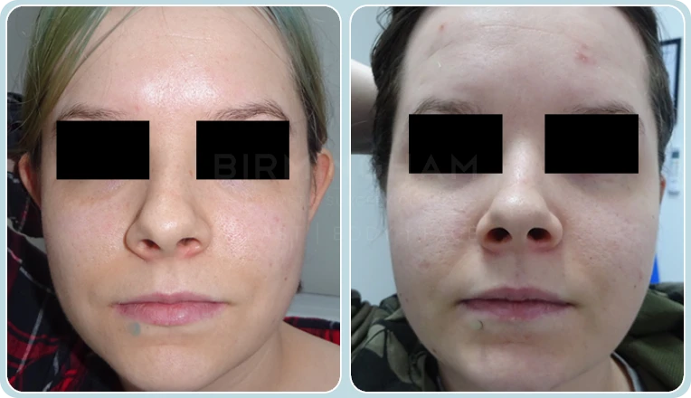 otoplasty before and after result