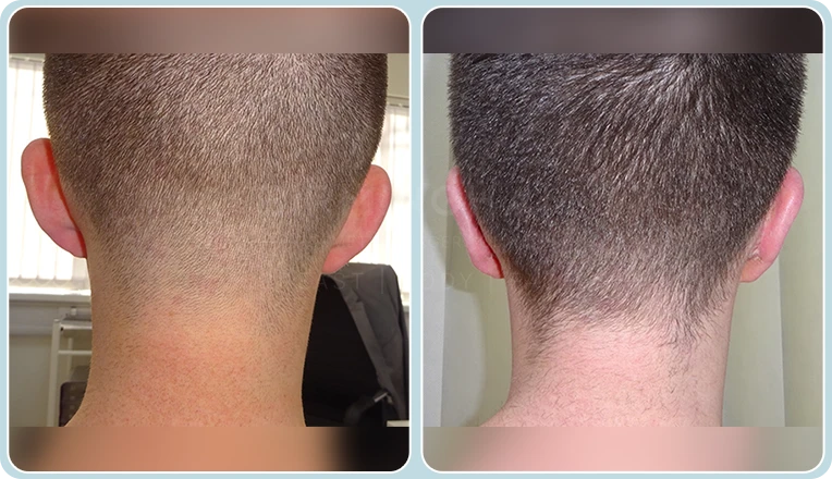 otoplasty before and after result