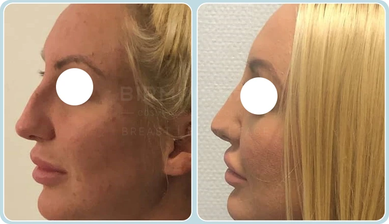 rhinoplasty before and after