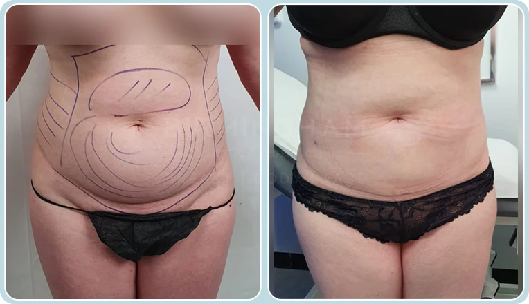 stomach vaser lipo before and after result