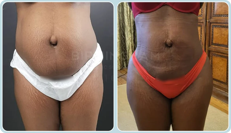 stomach vaser lipo before and after result