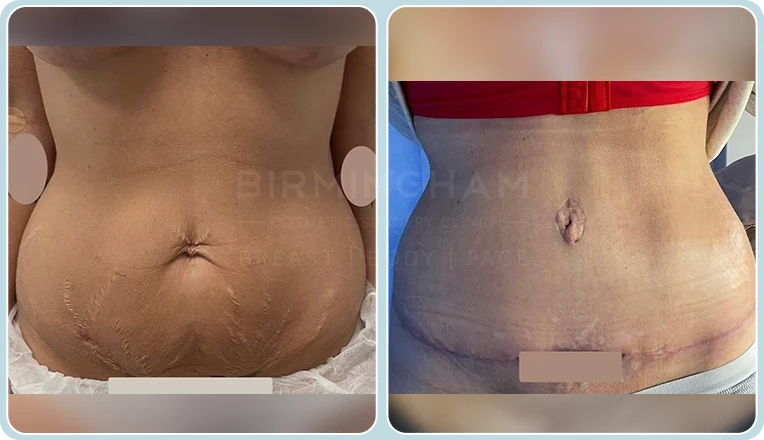 tummy tuck before and after result