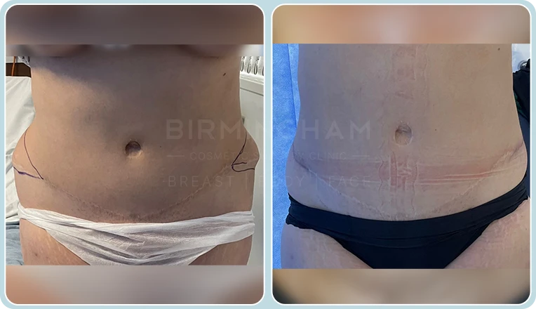 tummy tuck before and after result