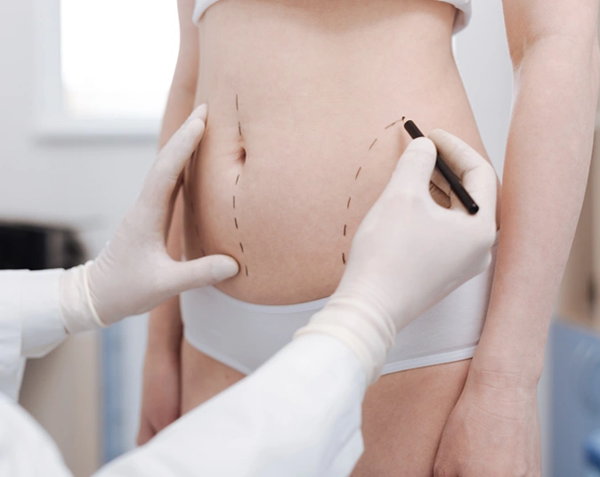 Surgeon marking abdomen before tummy tuck surgery to plan body contouring procedure.