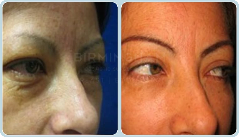 under eye blepharoplasty before and after result