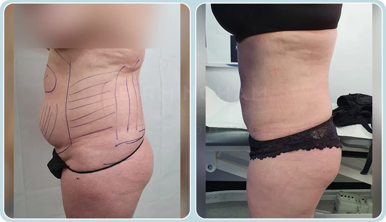 vaser lipo female abs before and after result