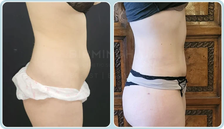 vaser lipo female abs before and after result
