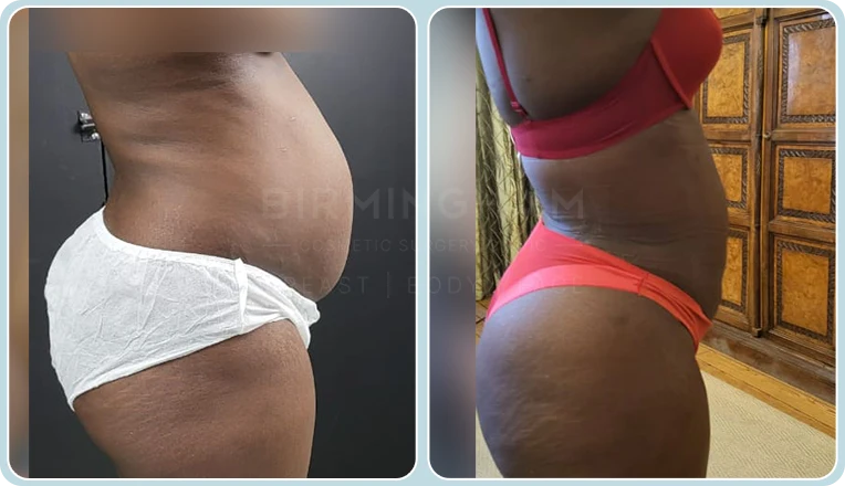 vaser lipo female abs before and after result