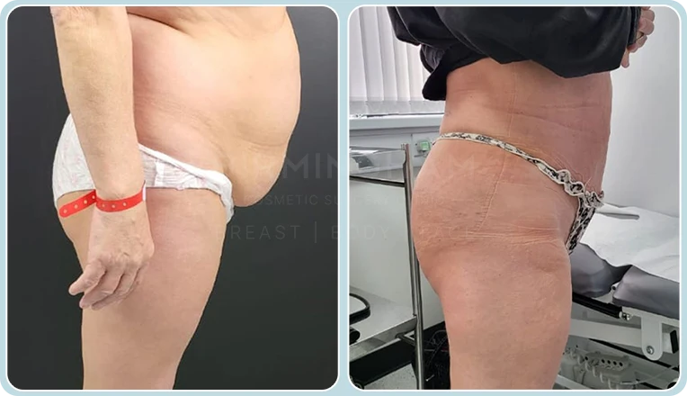 vaser lipo female abs before and after result